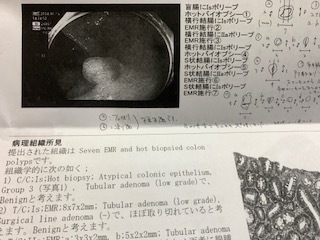 大腸ポリープ検査6.1.29.JPG
